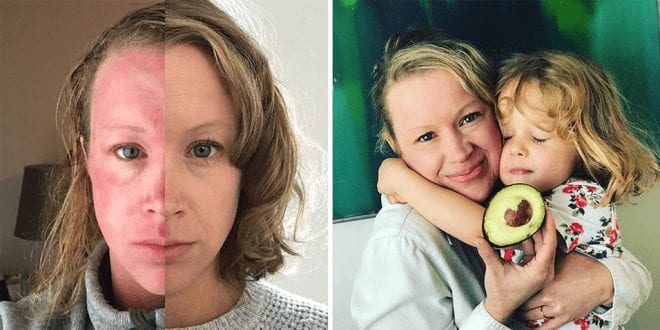 36-year old mum-of- two reversed her chronic, steroid resistant eczema with a vegan diet